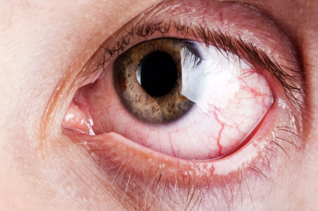 A close-up of a dry, irritated eye gone untreated