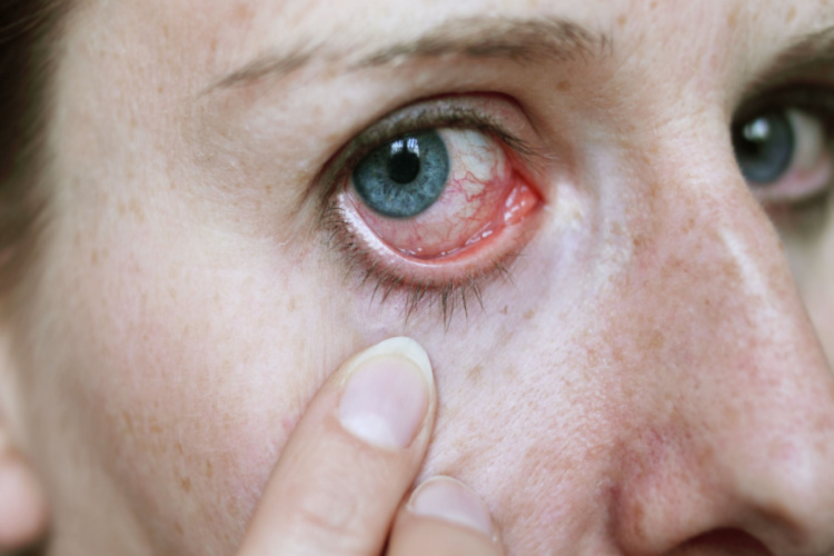 A woman pulling down her lower eye lid to make her dry, red, irritated eye more visible