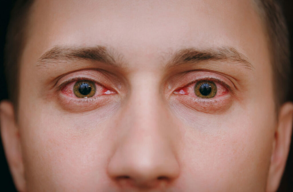 A close-up of a man's irritated, bloodshot eye with allergies.