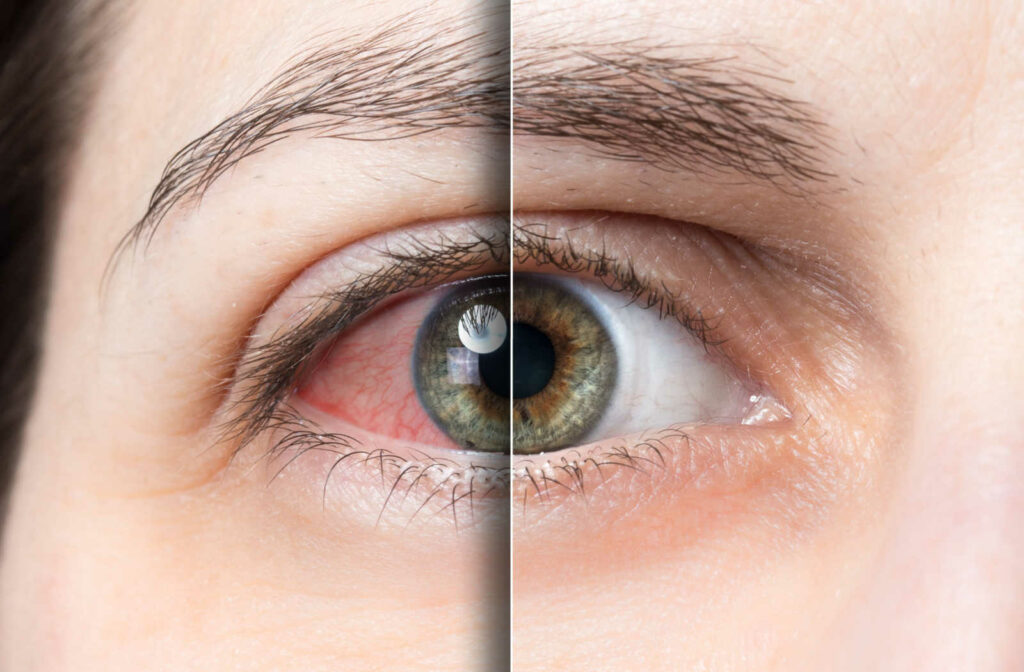 A comparison of a dry eye before and after dry eye treatment, showing red irritation on the left and a healthy eye on the right