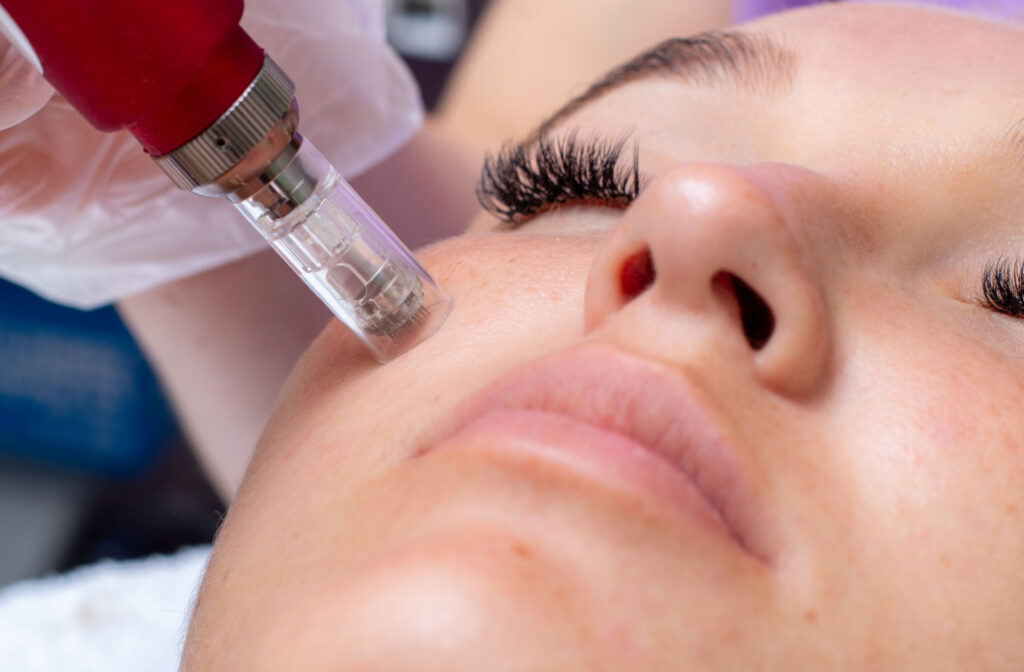 A close-up of woman undergoing micro needling
