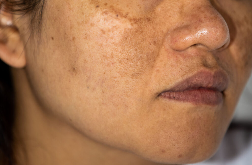 A close-up of woman's cheek with hyper pigmentation.
