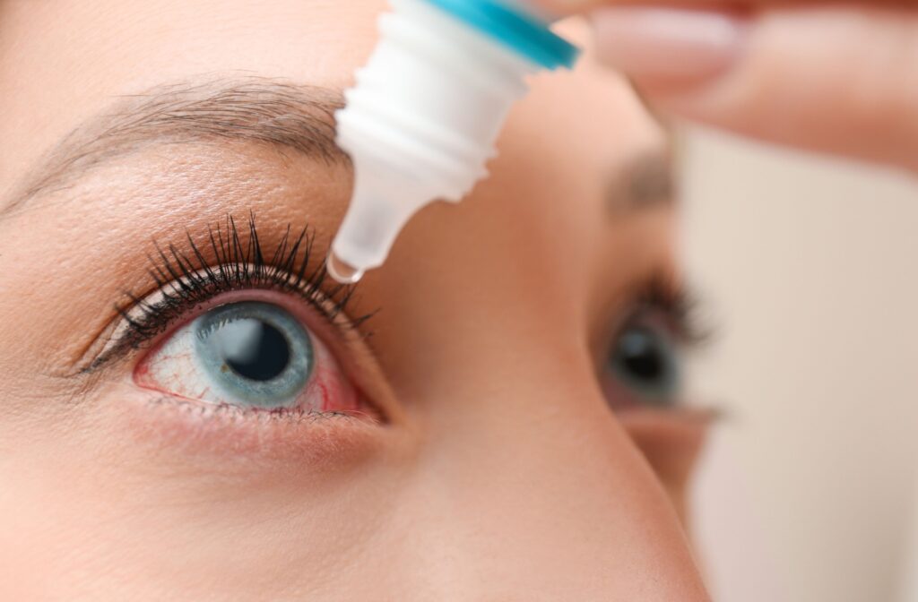 A woman carefully applying eye drops to a bloodshot eye to reduce the symptoms of her eye infection.