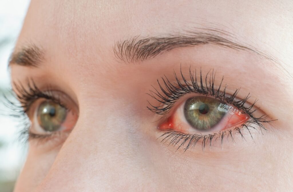 Close up red eyes caused by meibomian gland dysfunction