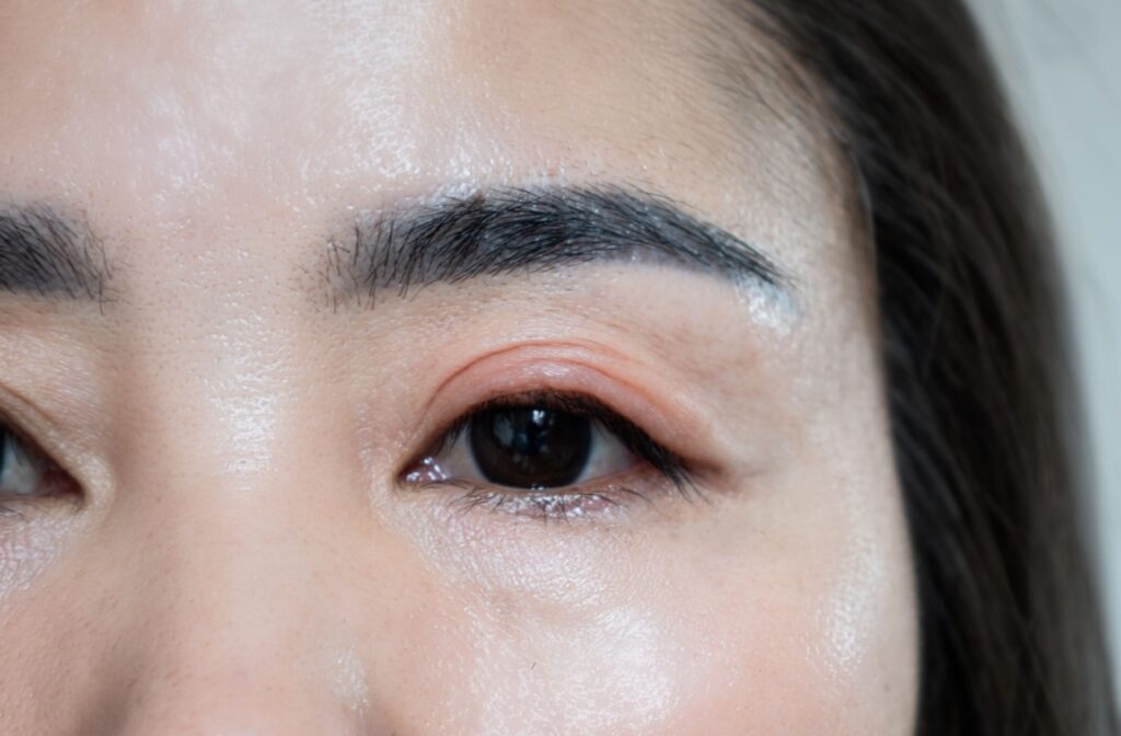 A close up of a red eye caused by blepharitis.